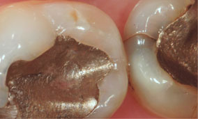 View of fillings at x8 magnification with Microscope Dentistry