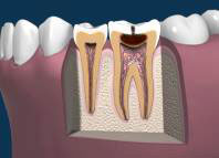 Late Stages of Tooth Decay Late Stages of Tooth Decay