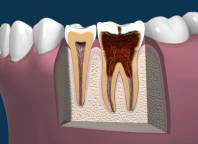Late Stages of Tooth Decay with Dead Tissue Late Stages of Tooth Decay with Dead Tissue