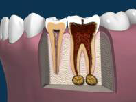 Late Stages of Tooth Decay with Diseased Bone Late Stages of Tooth Decay with Diseased Bone