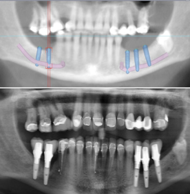 Nerve Laterilsation - Gate Dental Clinic Galway Nerve Laterilsation - Gate Dental Clinic Galway