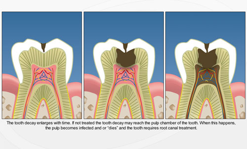 Dental Sealants - Gate Dental Clinic Galway
