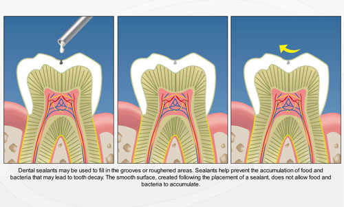 Dental Sealants - Gate Dental Clinic Galway
