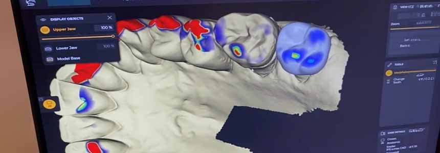 Gate InLab Design for Same Day Crowns. Gate InLab Design for Same Day Crowns