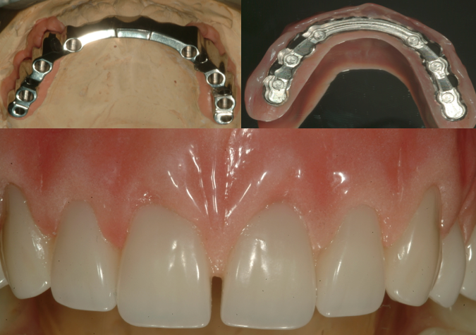 Dental implants Galway