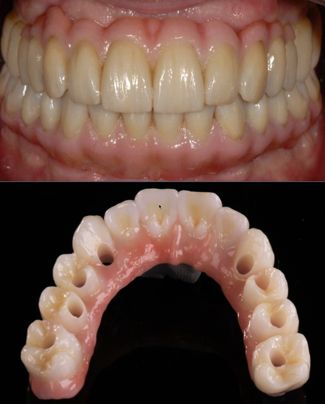 Dental implants Galway